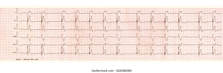 ECG Tape With Pacemaker Arrhythmia (ventricular Stimulation)