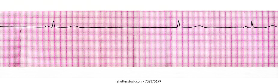 147 Sinus arrest Images, Stock Photos & Vectors | Shutterstock