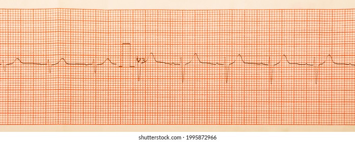 ecg-test-results-on-millimeter-paper-stock-photo-1995872966-shutterstock