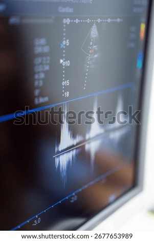 Echocardiogram analysis shown on screen. An echocardiogram result is shown on a monitor, showcasing heart activity with various waveforms and measurements.