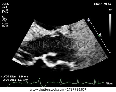 Echocardiogram Showing Left Ventricular Outflow Tract  Diameter Measurement — Cardiac Ultrasound
