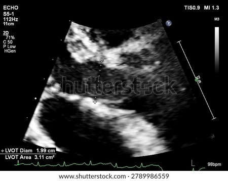 Echocardiogram Showing Left Ventricular Outflow Tract  Diameter Measurement — Cardiac Ultrasound
