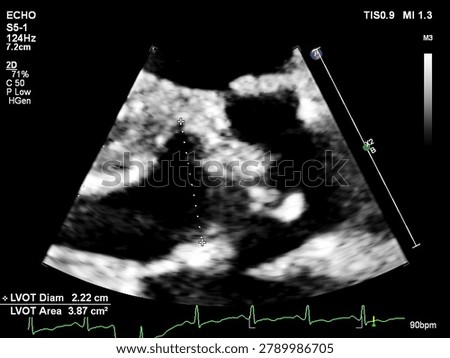 Echocardiogram Showing Left Ventricular Outflow Tract  Diameter Measurement — Cardiac Ultrasound
