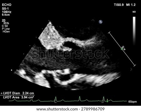 Echocardiogram Showing Left Ventricular Outflow Tract  Diameter Measurement — Cardiac Ultrasound

