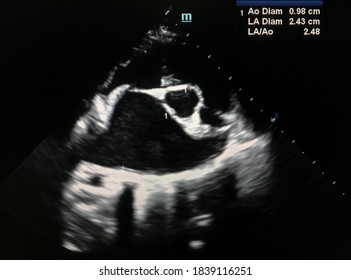 Echocardiographic Finding Shows Left Atrium To Aorta Ratio (LA:Ao Ratio) Found Left Atrial Enlargement In Mitral Valve Degenerative Disease In Dog