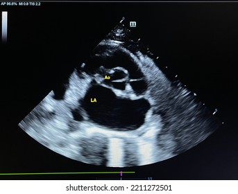 Echocardiographic Finding Shows Short Axis Of The Heart At Left Atrium (LA) And Aorta (Ao) Level In Feline Cardiomyopathy