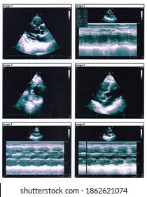 Echocardiography in 2d and M-Mode (TTE). Good LV systolic function
