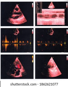 An echocardiography report of a male patient. No regional wall motion abnormality noted.