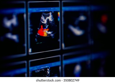 Echocardiography (ultrasound) Machine