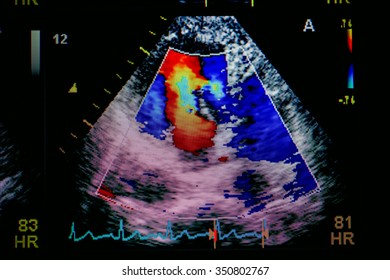 Echocardiography (ultrasound) Machine