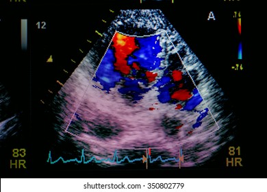 Echocardiography (ultrasound) Machine