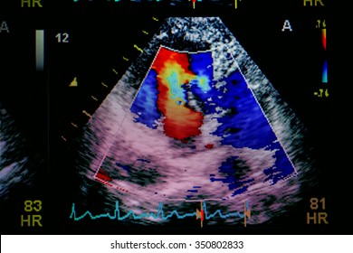 Echocardiography (ultrasound) Machine