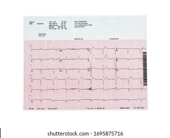 Ecocardiography Report (ECG) Showing Irregular Heartbeat Isolated On White