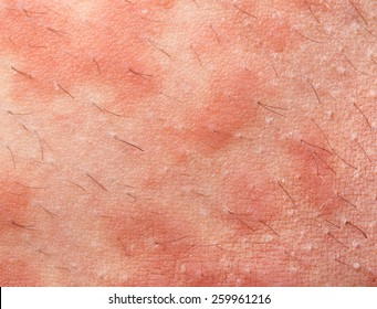 Eczema Atopic Dermatitis Symptom Skin Texture