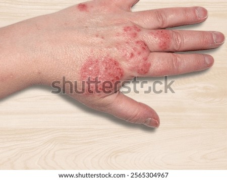Eczema is a chronic skin condition causing red, itchy, and inflamed patches. It’s often triggered by allergens or irritants and managed with moisturizers, medicated creams, and avoiding triggers.