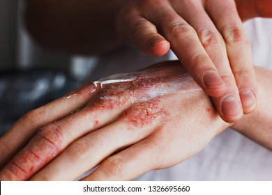 Eczema on the hands. The man applying the ointment , creams in the treatment of eczema, psoriasis and other skin diseases. Skin problem concept