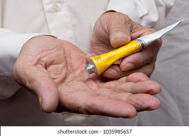 Eczema on the hands. Ointment on the hands of an elderly person. Retired applying the ointment , creams in the treatment of eczema, psoriasis and other skin diseases