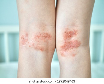 Eczema on kid's legs. Atopic dermatitis close up. Allergy spots and red itchy skin inflammation on child's feet