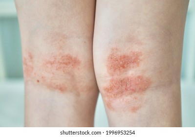 Eczema On Kid's Legs. Atopic Dermatitis Close Up. Allergy Spots And Red Itchy Skin Inflammation On Child's Feet