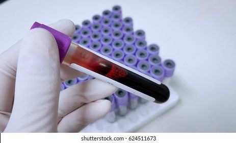 EDTA Blood sample for Complete blood cell count(CBC) testing.
