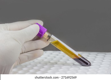 EDTA Blood For Viral Load Test In Laboratory