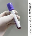 EDTA test tube Anticoaglant CBC test.Blood sample.
