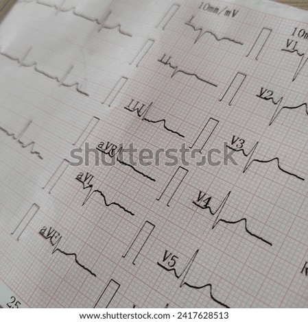 Educational Image of a Paper with an Electrocardiogram (ECG) Graph: Informative Visual on Heart Health and Cardiac Monitoring for Medical Training and Healthcare Concepts