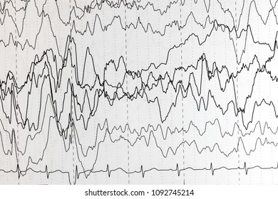 EEG Of The Pediatric Patients, Problems In The Electrical Activity Of The Brain.Abnormal EEG.