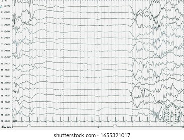 EEG Of The Pediatric Patients, Problems In The Electrical Activity Of The Brain.Abnormal EEG.