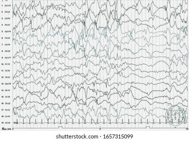 EEG Of The Pediatric Patients, Problems In The Electrical Activity Of The Brain.Abnormal EEG.