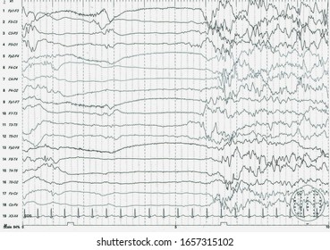 EEG Of The Pediatric Patients, Problems In The Electrical Activity Of The Brain.Abnormal EEG.