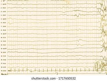 EEG Of The Pediatric Patients, Problems In The Electrical Activity Of The Brain.Abnormal EEG.