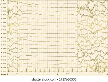 EEG Of The Pediatric Patients, Problems In The Electrical Activity Of The Brain.Abnormal EEG.