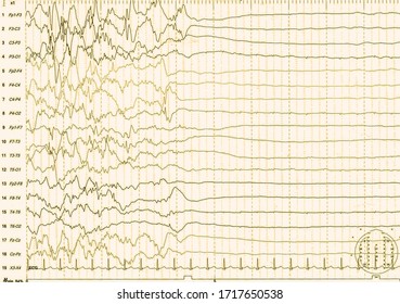 EEG Of The Pediatric Patients, Problems In The Electrical Activity Of The Brain.Abnormal EEG.