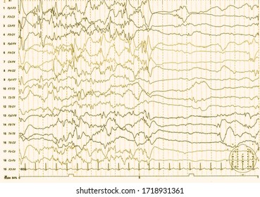 EEG Of The Pediatric Patients, Problems In The Electrical Activity Of The Brain.Abnormal EEG.