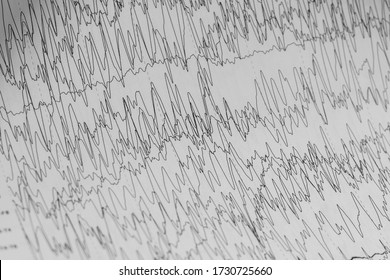 EEG Of The Pediatric Patients, Problems In The Electrical Activity Of The Brain.Abnormal EEG.