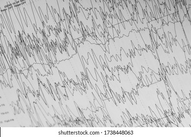 EEG Of The Pediatric Patients, Problems In The Electrical Activity Of The Brain.Abnormal EEG.