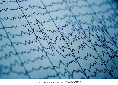 EEG wave in human brain, brain wave patterns on electroencephalogram, problems in the electrical activity of the brain