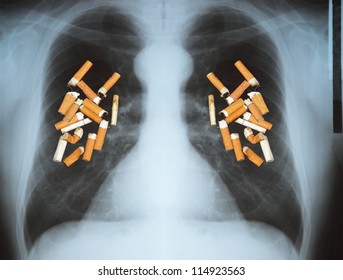 Effects Of Cigarette Smoking - Lung Cancer.