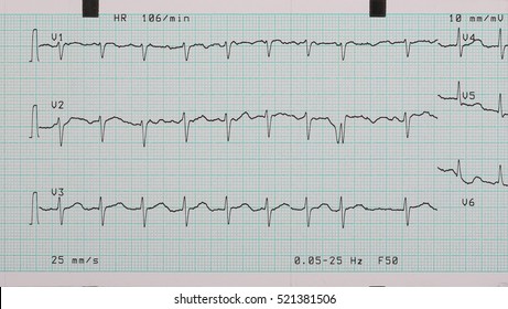 EKG Arrhythmia Absoluta, Printout Background