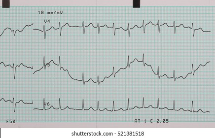 EKG Arrhythmia Absoluta, Printout Background