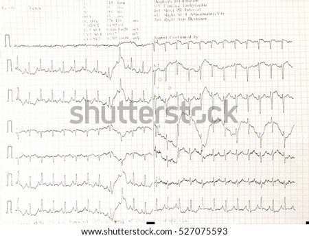 ekg graph paper electrocardiogram medical concept stock photo edit ekg graph paper