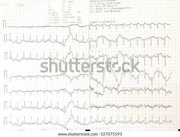 Ekg Graph Paper Electrocardiogram Medical Concept Stock Photo (Edit Now ...