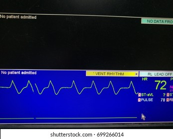EKG Monitor Show Ventricular Tachycardia