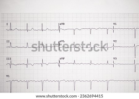 EKG, on paper, showing sinus rhythm otherwise known as a 12 lead EKG or ECG used to diagnosis heart problems.