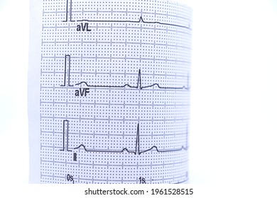 Ekg Paper Showing ECG Results, White Background.