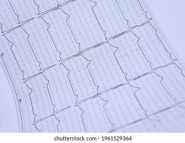 The Ekg Paper Shows The Results Of The ECG.