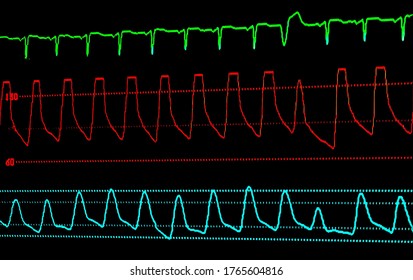 EKG, Pulse, BP And Respiration ICU Monitor Screen