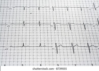 EKG Readout