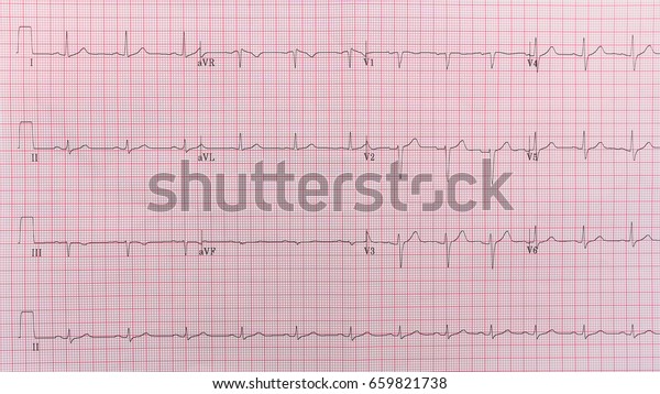 Ekg Report Paper Closedup Top View Stock Photo (Edit Now) 659821738